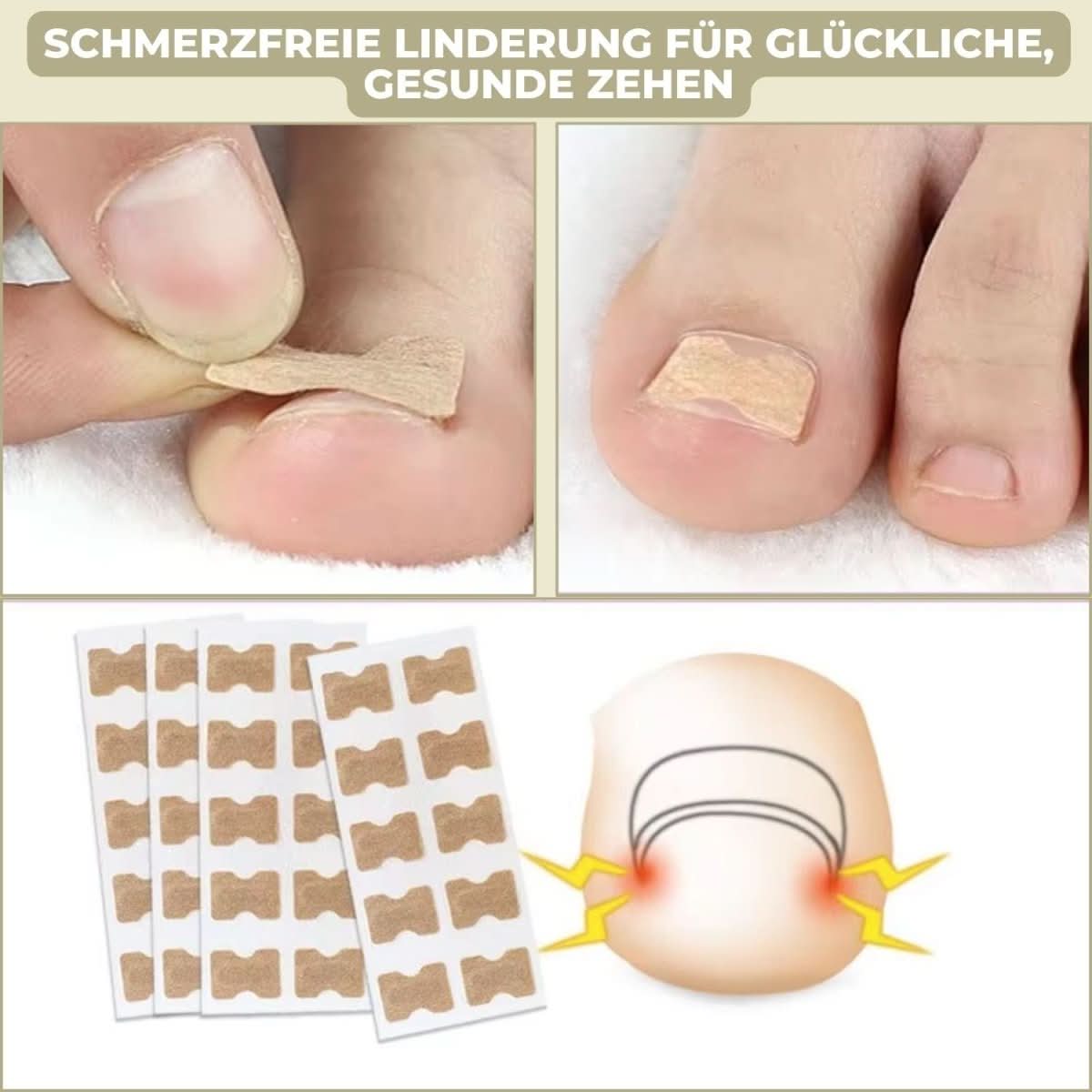 NovaNail Sanfte Nagelkorrektur bei eingewachsenen Nägeln und Schmerzen