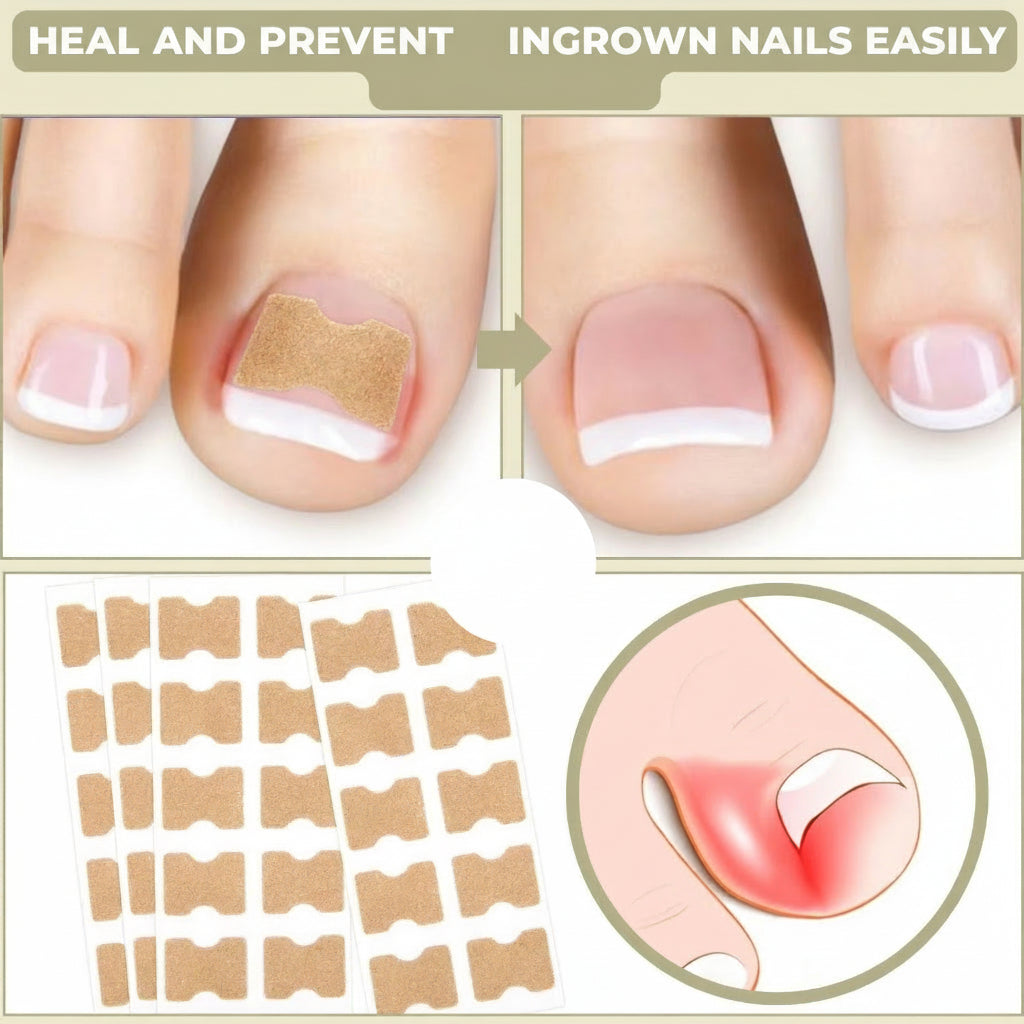 Toenail Correction Patches For Sore Toes And Natural Growth