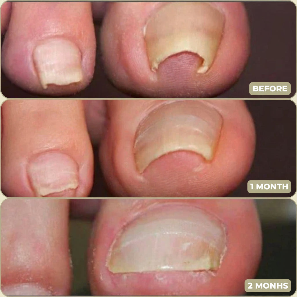 Toenail Correction Patches For Sore Toes And Natural Growth